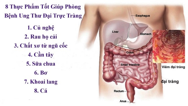 8 Thực Phẩm Hữu Ích Ngừa Ung Thư Đại Trực Tràng