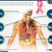 Người Việt ung thư dễ chết do thường phát hiện muộn
