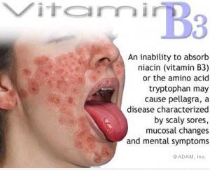 Triệu chứng thiếu hụt Vitamin B3​